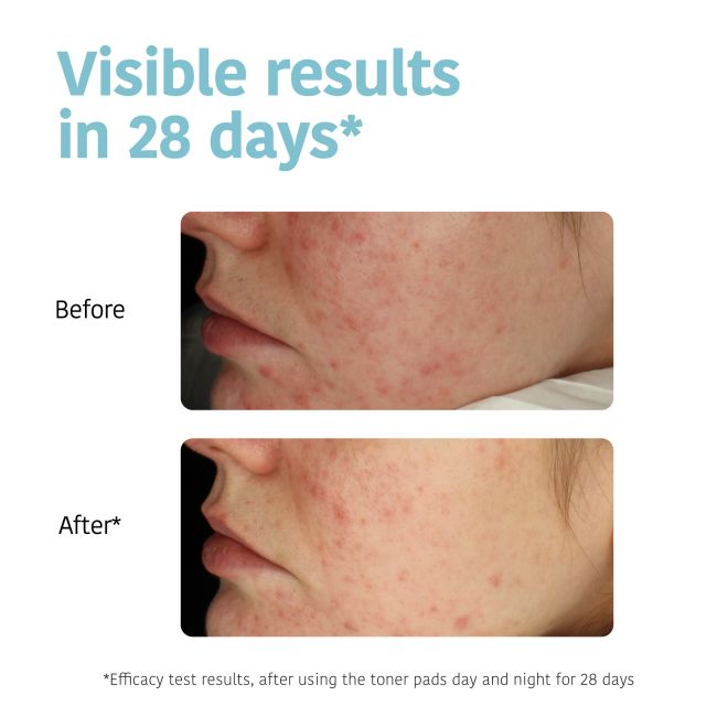 Discos Tônicos Esfoliantes & Anti-Imperfeições-Acne Iroha x50