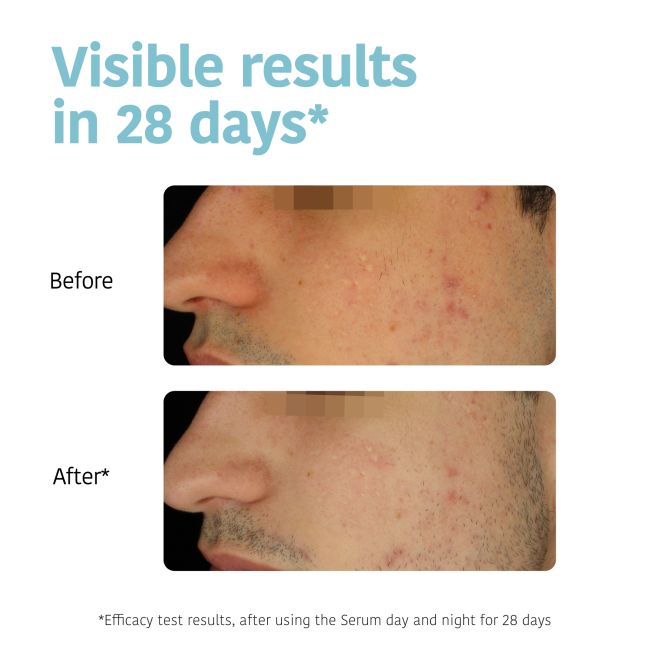 Serum zur Vorbeugung & Korrektur von Unreinheiten - Akne Iroha 30ml