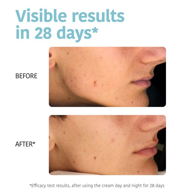 Crème Gezichtsverzorging voor de vette huid & anti-onzuiverheden-Acne Iroha 30ml