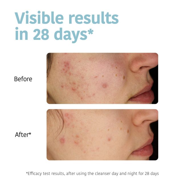 Gel Reinigende en Zuiverende Anti-Onzuiverheden-Acne Iroha 150ml