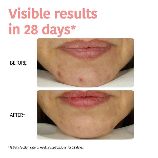 Masque peeling facial Perfect Skin com ácido glicólico Iroha Nature