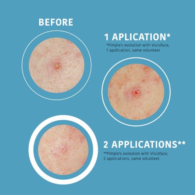 Patchs para rosto e corpo SOS Botões Iroha Nature